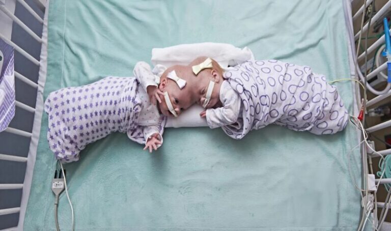 Siamese twins were separated a year after birth: this is how they look seven years later