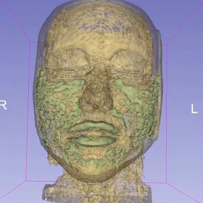 Doctor Reveals: MRI Scan Of The Face Of A 33-Year-Old Woman Reveals Where All Of Her Filler Went